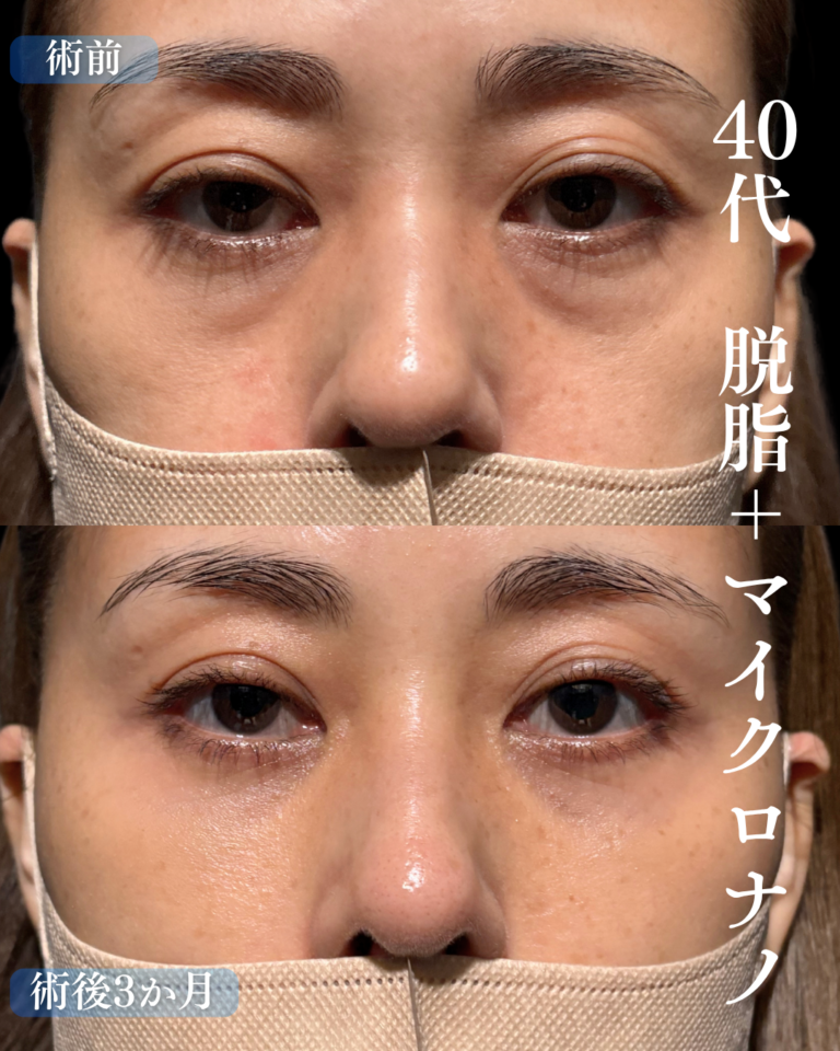 40代女性　脱脂+マイクロナノ